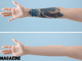 How Laser Tattoo Removal Actually Works Step-by-Step