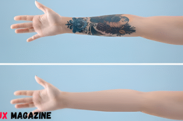 How Laser Tattoo Removal Actually Works Step-by-Step