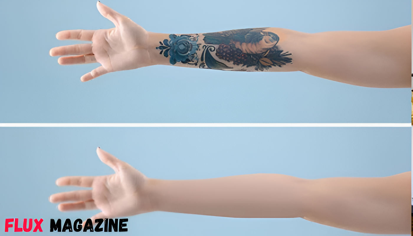 How Laser Tattoo Removal Actually Works Step-by-Step
